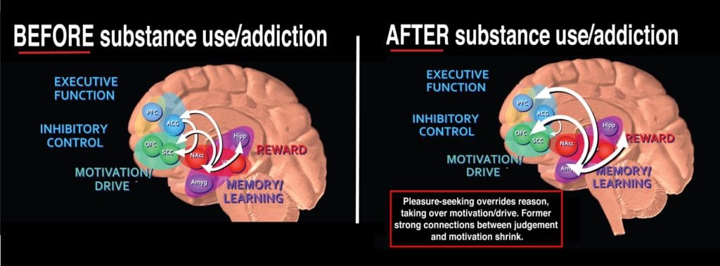 infographic showing brain before and after substance addiction